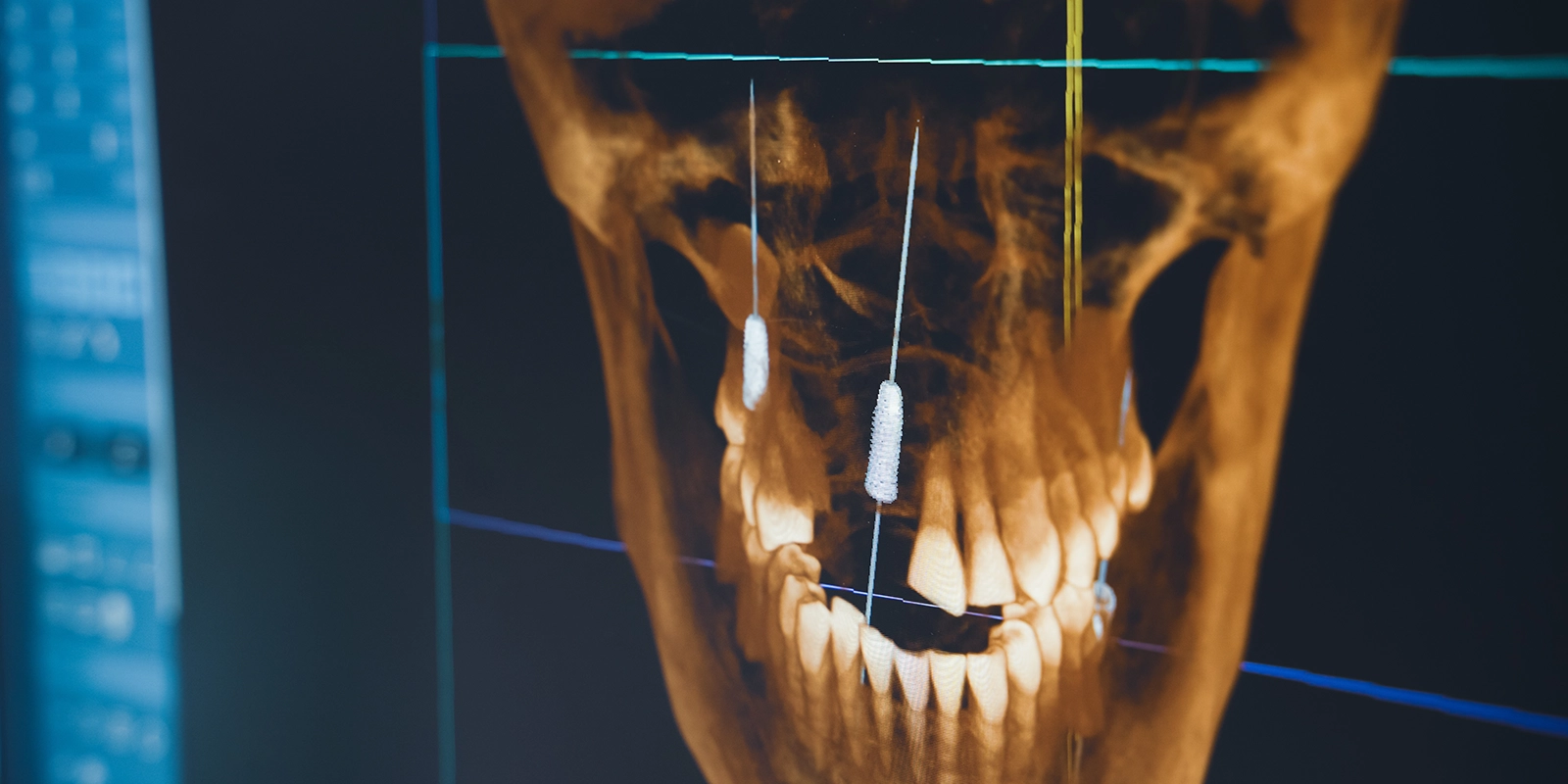インプラント治療の適応と診断