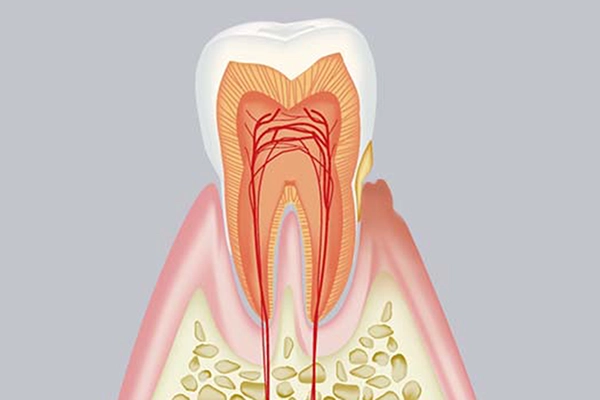軽度歯周病の治療