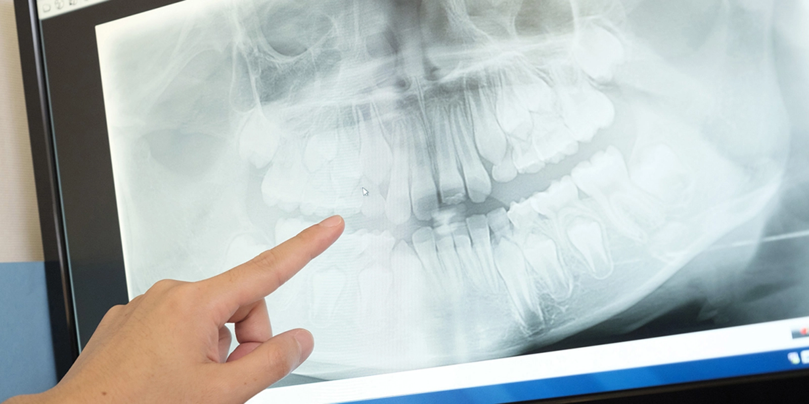 根管治療の成功率と予後