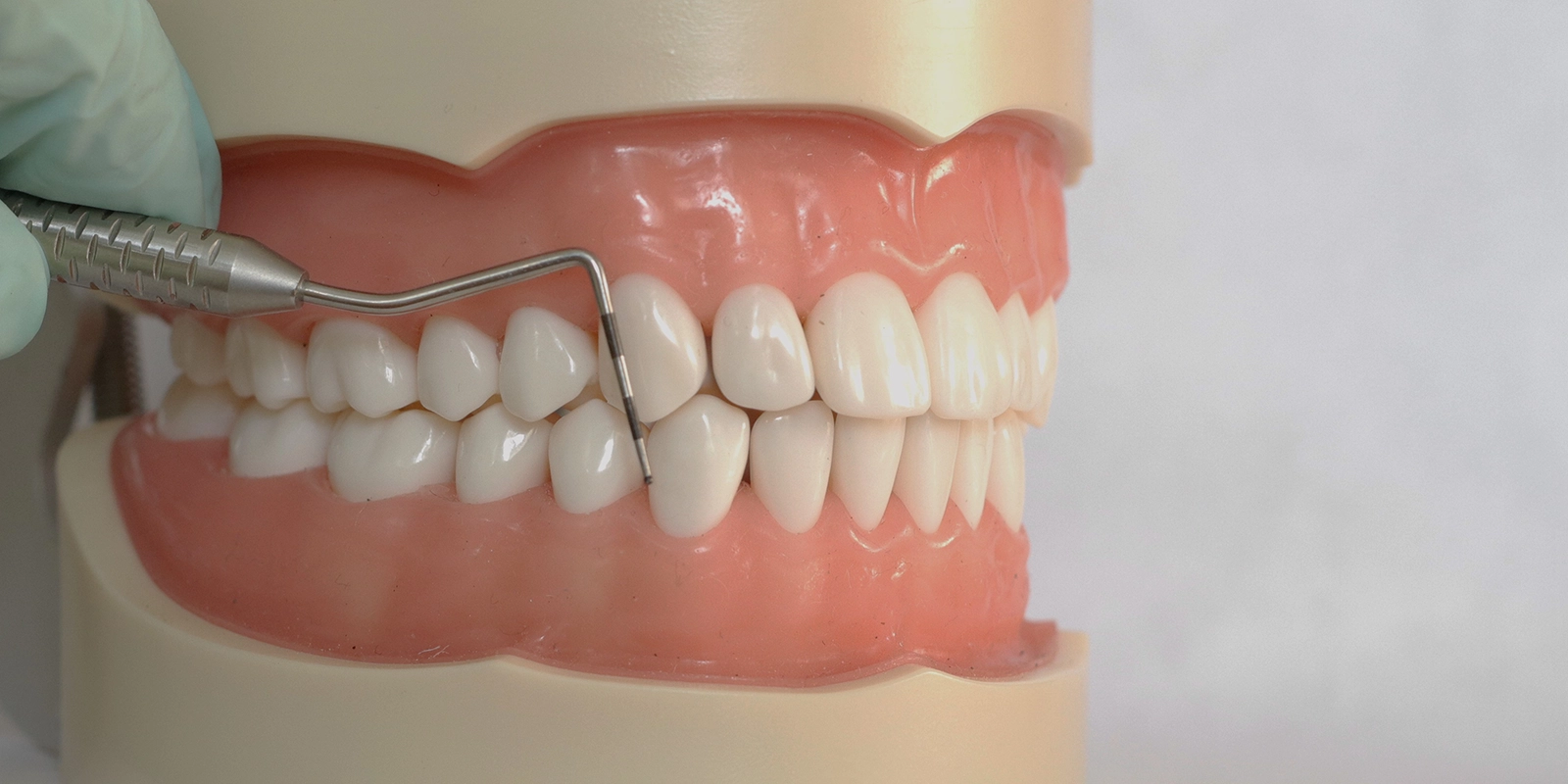 ホワイトスポットができる原因